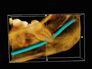 3D_CT_impacted_wisdom_tooth